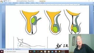 Hernia in Arabic 10  Indirect Inguinal hernia  part 1   by Dr Wahdan [upl. by Nolyat]