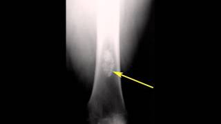 Proximal femur anatomy [upl. by Leahsim243]