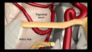 Treatment for Trigeminal Neuralgia UCSF Neurosurgery [upl. by Bunch]